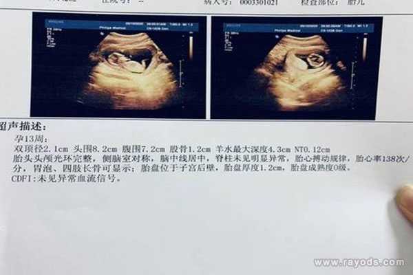 上海助孕女孩包成功_B超三条白线是女孩 NT三个亮点是男孩女孩